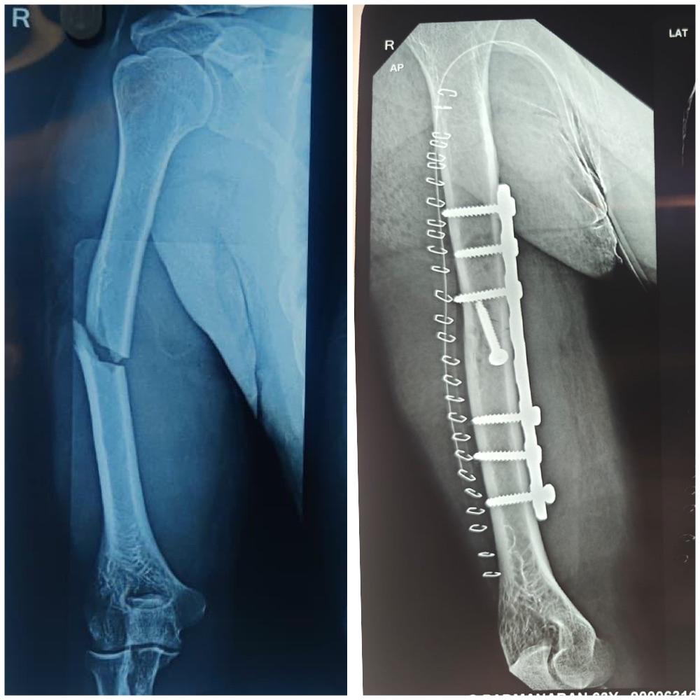 Complex Arm Fracture - Successful Surgical Repair