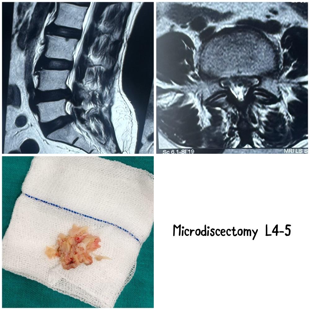 Microdiscectomy - Relief from Sciatic Pain